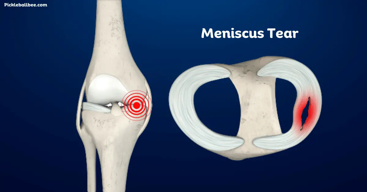 Can I play Pickleball With A Torn Meniscus? Risks & Tips